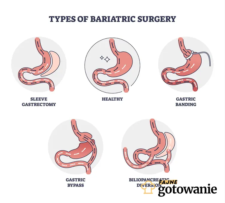 Różne typy operacji bariatrycznej, a także jakie są zalecenia po zabiegu.