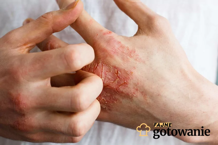 Sucha i podrażniona skóra, łamliwe i wypadające włosy a także zmęczenie - wszystko to może świadczyć o niedoborze kwasów omega-3 Przesuszone dłonie z ranami