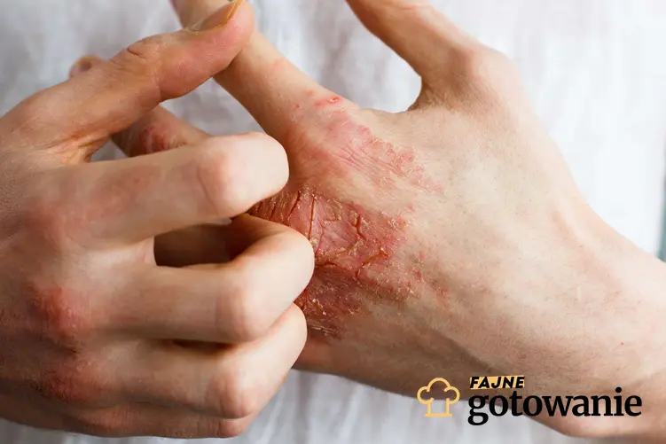 Dłonie, które są przesuszone oraz z ranami, a także objawy, które świadczą o niedobrze omega-3